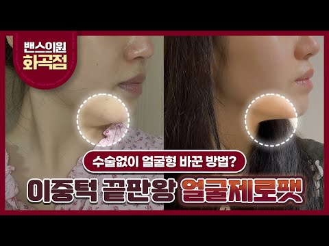 이중턱 끝판왕 얼굴제로팻으로 수술없이 얼굴형 바꾸는 법