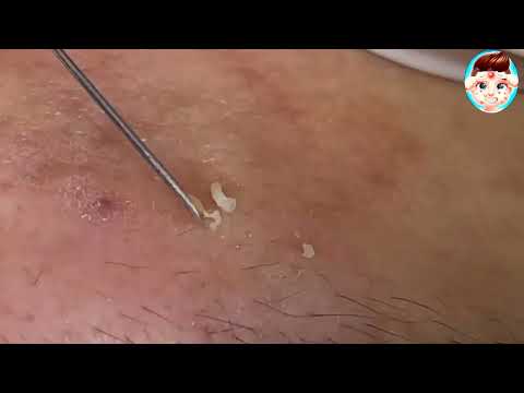 blackhead removal