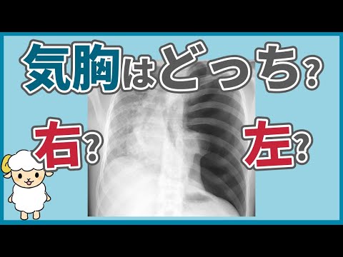 気胸のレントゲンを徹底解説【動画内で読めるようになります】