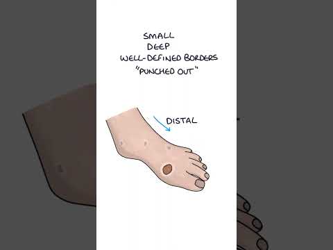 Comparing Arterial and Venous Ulcers #medicine #vascularsurgery #medicalstudent