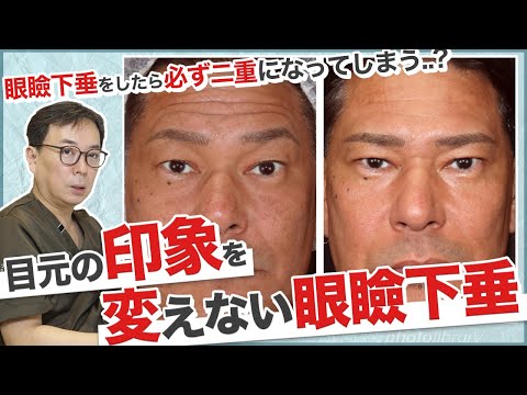 目元の印象を変えない眼瞼下垂！周りにバレずに機能はしっかり改善させる。症例写真付きで解説します！