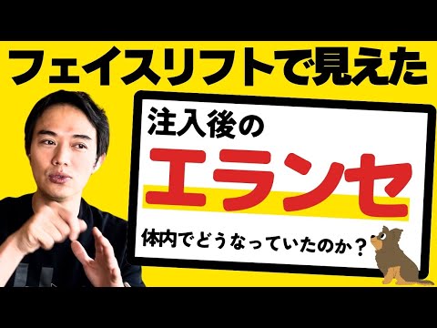 【さらに問題発生！】「エランセ」って何？ヒアルロン酸より長持ちする？溶けない！？フェイスリフトで開けてわかる真実(続編)