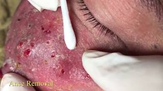 Best Pimple Popping Videos - Blackheads