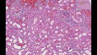 Histopathology Kidney--Interstitial nephritis