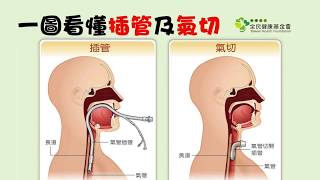 一圖看懂插管、氣切的差別　原來這樣選對病人比較好