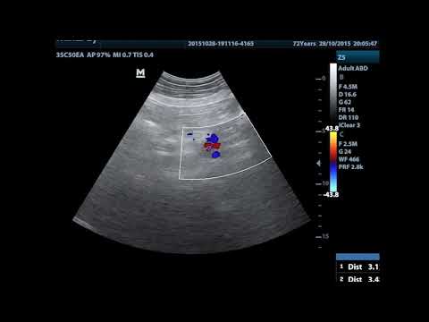 Common Iliac aneurysm-Duplex Scanning Video