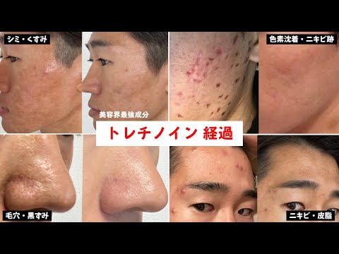 【完全版】トレチノイン経過まとめ！効果的な使い方・おすすめの塗り方【毛穴・ニキビ・シミ・ニキビ跡】