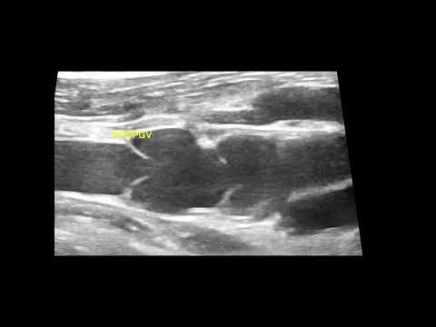 Double Valve in Popliteal Vein- Ultrasound  Video