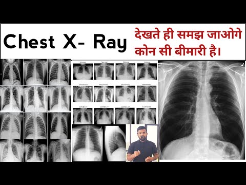 Chest X Ray | X Ray | X Ray Reading | Pneumonia | Lungs Effusion | X Ray Technician | Doctor | bhms