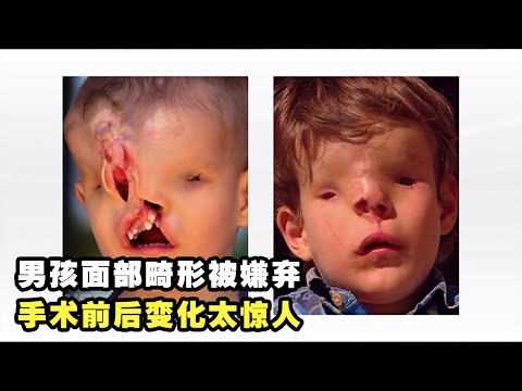 3岁男孩天生面部畸形，被无数人嫌弃，父母不忍抛弃，手术变化太惊人！（纪录片）