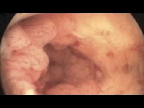 Diagnosis of Endometrial Carcinoma on Hysteroscopy