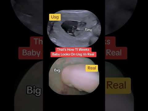 11 weeks baby usg vs real #babyultrasound #baby #ultrasound #pregnancyscan#pregnant #ultrasoundscans