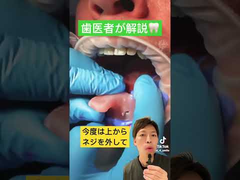 インプラントの型取り🦷#implant #入れ歯 #ブリッジ #再生医療 #型どり #歯医者 #denture #歯科衛生士 #歯がない