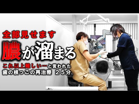 『 歯の根っこに膿が溜まって治らない…』再治療２５分ノーカット　＃根っこ　＃膿が溜まる　＃根尖病巣　＃歯医者　＃フィステル　＃瘻孔