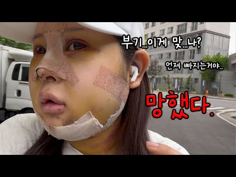 윤곽 수술 했는데 🐶망했다(찐 현실 주의 수술직후~한달차있음) [혜주Vlog]