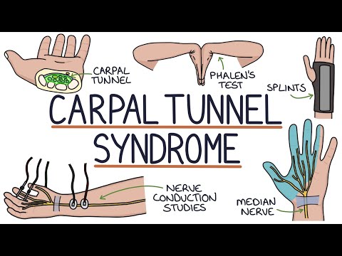 Understanding Carpal Tunnel Syndrome