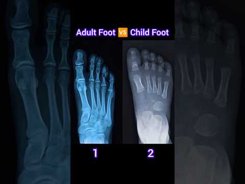 Adult Foot X ray 🆚Child Foot