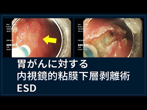 胃がんに対する内視鏡粘膜下層剥離術(ESD)