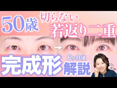 【症例解説】50歳切らない二重術なのに驚きの若返り！金先生の二重はこうつくる【クイックコスメティーク】