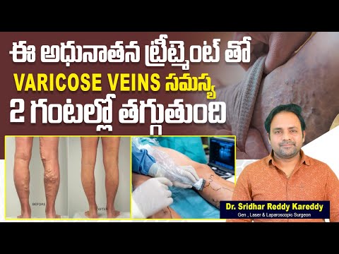 Glue Therapy for Varicose Veins || How to Cure Varicose Veins Naturally in Telugu | Treatment Range