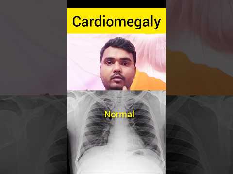 Cardiomegaly