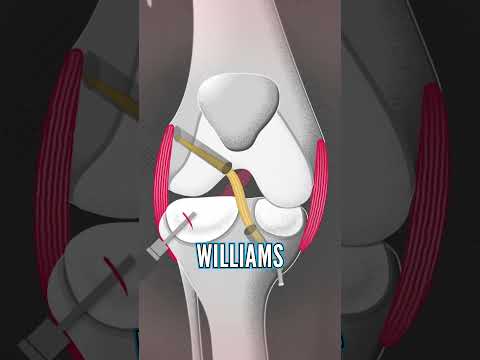 Neil's Knee Surgery Explained!