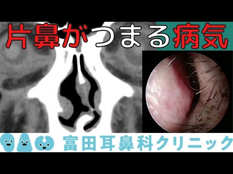 片鼻だけつまる場合に考える病気を解説