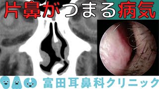 片鼻だけつまる場合に考える病気を解説