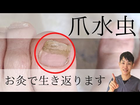 【爪水虫、爪白癬】お灸で爪は生き返ります┃練馬区 大泉学園 仙灸堂