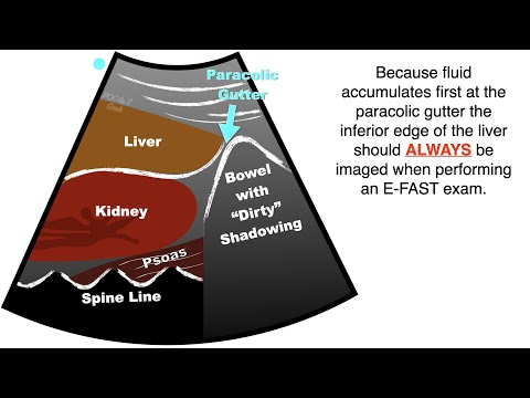 POCUS:  EFAST - Progression free fluid in the Right Upper Quadrant (RUQ)