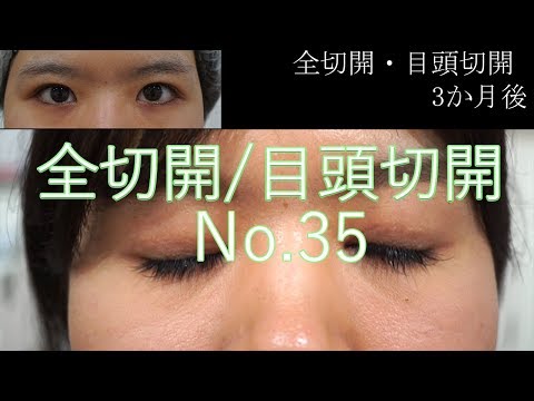 全切開二重35　目頭切開32　もともと埋没法で二重にしていただが少し幅を広げて全切開と目頭切開を行った方