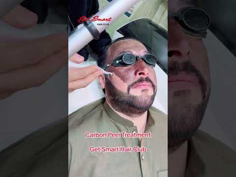 Carbon Laser treatment #getsmarthairclub