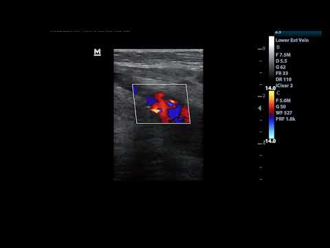 Varicose veins secondary to right heart failure