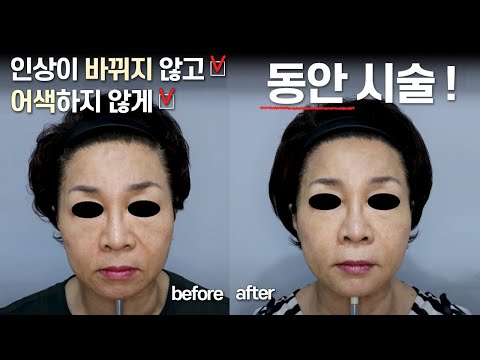 동안으로 만드는 "최신" 이마 필러 시술 법 !!