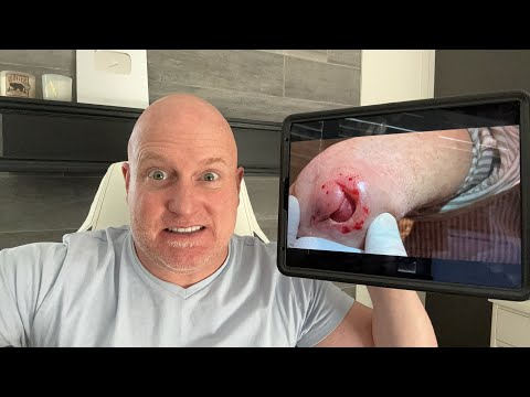 Going live now at MrPopZit Live! Laceration repair - a unique case.