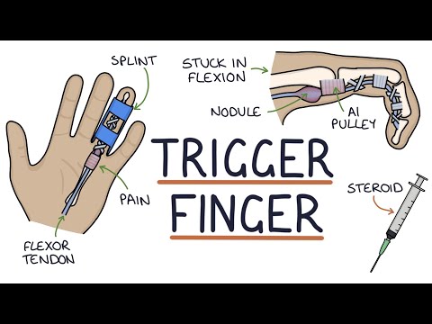 Understanding Trigger Finger (Stenosing Tenosynovitis)