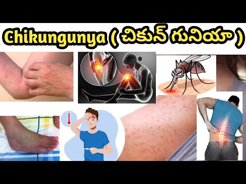 Chikungunya Symptoms and Treatment in Telugu| చికెన్ గునియా లక్షణాలు