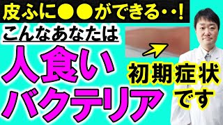 【放置禁止】「人食いバクテリア」劇症型溶血性レンサ球菌感染症の5つの初期症状、治療や予防を医師が解説