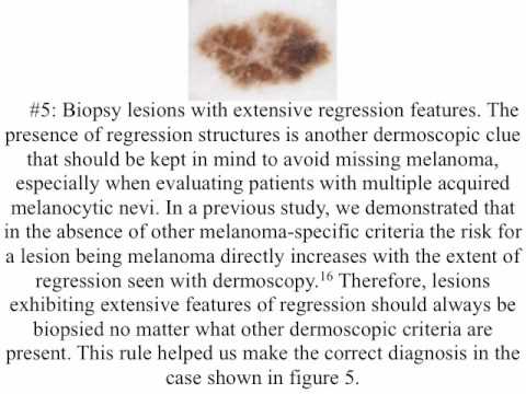 Melanoma incognito by Dr. Giuseppe Argenziano 2/2