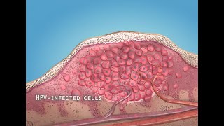 What are warts (HPV)? - 3D animation