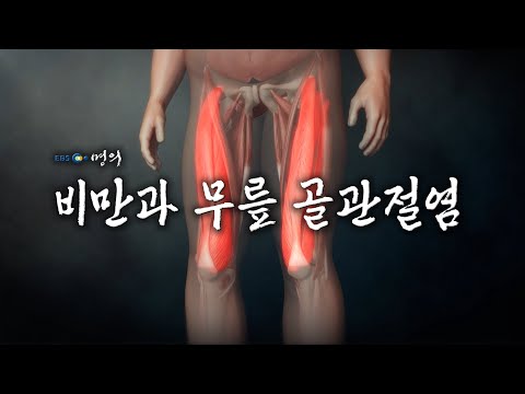 [명의 의학백과📖] 비만과 무릎 골관절염