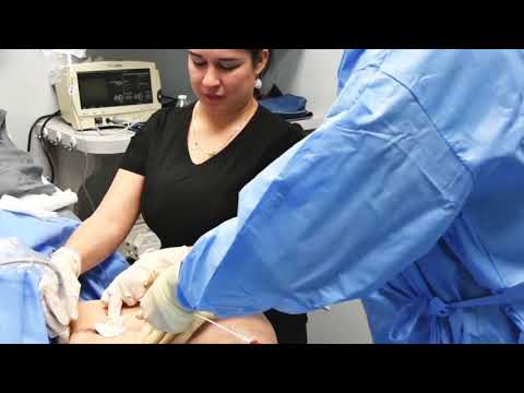 Endevenous Laser Ablation at Florida Vein Center