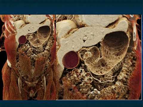 CT Evaluation of GI Bleeding - Part 1