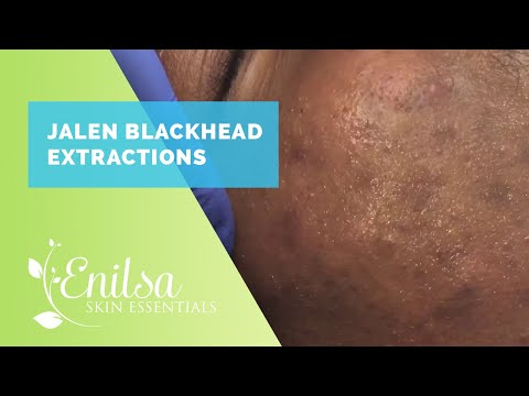 Jalen Blackhead Extractions & More