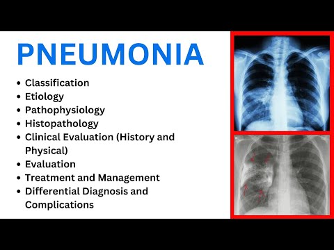 Pneumonia  - Classification, Etiology, Pathophysiology, Histopathology, Clinical Symptoms, Treatment