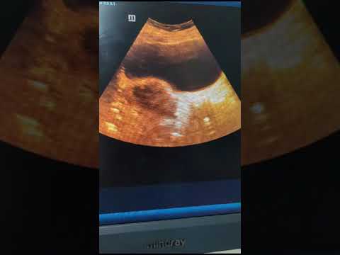 gyne scan #pregnancy #ultrasound #sonographer #medicine #ultrasoundtech #health