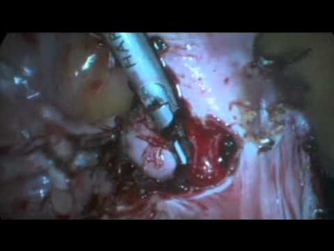 TLH (Total Laparoscopic Hysterectomy) for fibroid uterus Dr Rooma Sinha