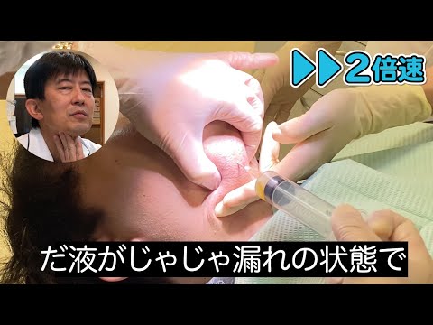 【巨大なガマ種】OK-432(ピシバニール)注入療法▶︎▶︎２倍速解説