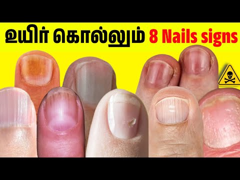 8 dangerous nail sign| உங்க விரல் நகம் நல்லா இருக்கா? Nail signs of Disease