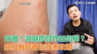 好癢！蕁麻疹發作如何解？網紅醫師教你改善攻略｜三立新聞網SETN.com